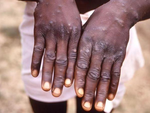 BBC Mundo: infección de mpox