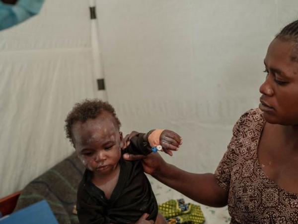 BBC Mundo: infección de mpox